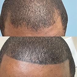 Confidence hits different with a full hairline.